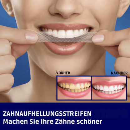 SmileKit – Komplette Zahnaufhellung in 30 Minuten